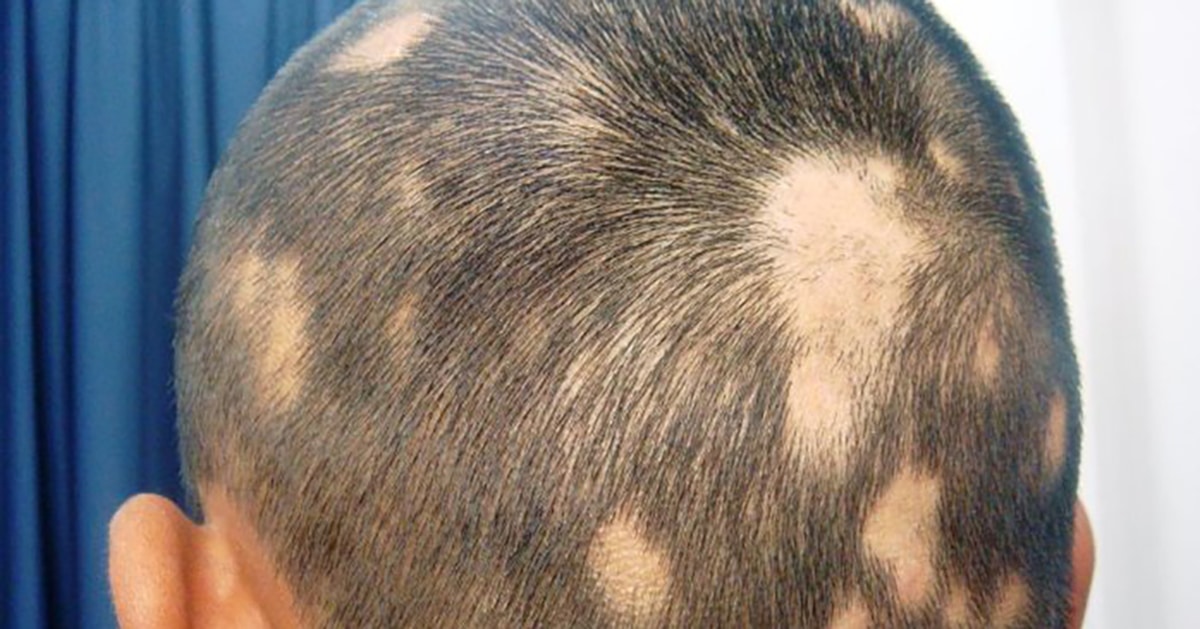 Image result for alopecia