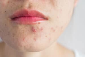 Acne-and-early-treatment