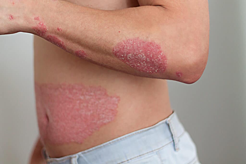 Biologics Hives Psoriasis Hidradenitis Suppurativa There Is An
