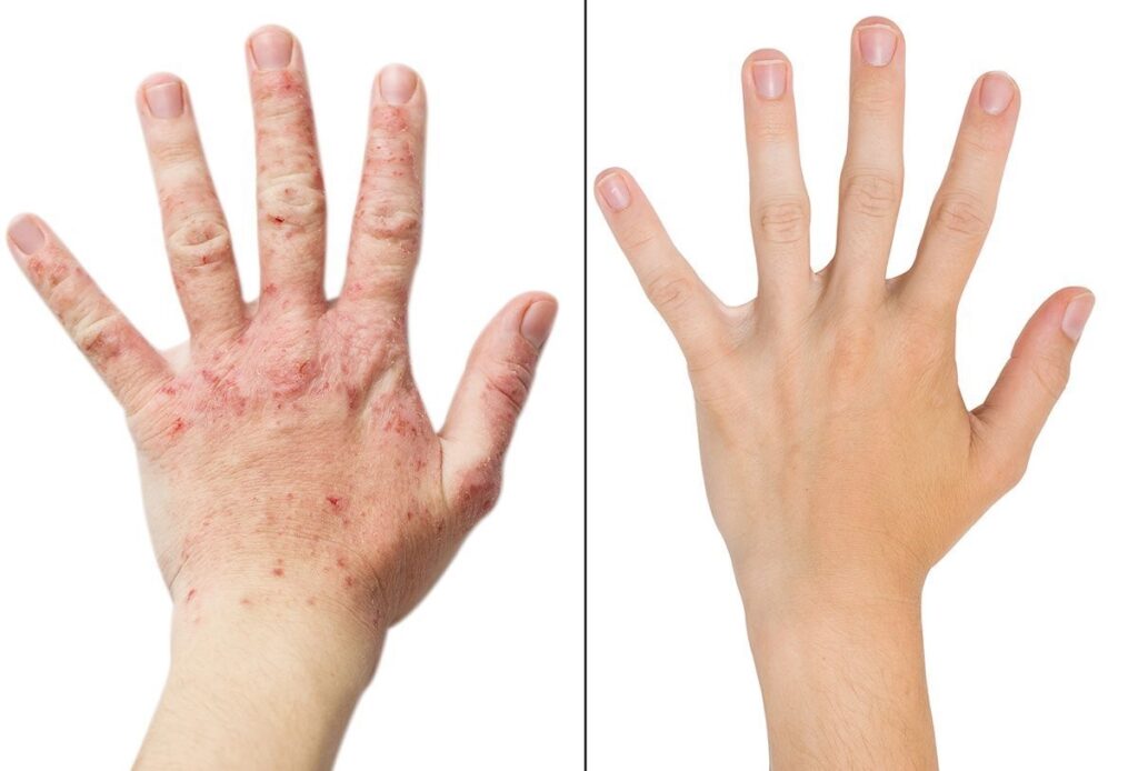 ECZEMA? RED, SORE, ITCHY, DRY SKIN……LETS GET RID OF IT! 😊 - Hope  Dermatology